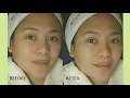 NISCE SKIN MEDISPA | Cutera Laser Genesis  @Cheneleng Pili