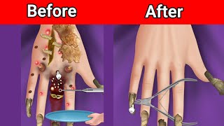 ASMR Best treatment for hand,ingrown nails, perennial toenail removal, deep clean treatment