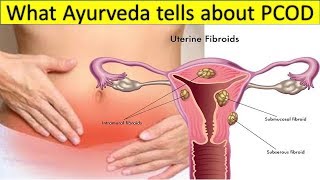 Great info about PCOD / PCOS as in Ayurveda