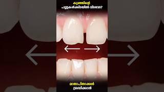 Why Does My Child Have a Teeth Gap? | Pediatric Dentistry Explained | In Malayalam #dentistry