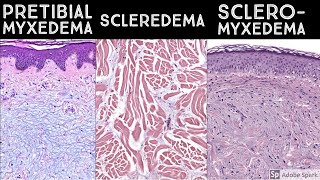Pretibial Myxedema vs Scleredema vs Scleromyxedema - Dermatopathology "Sound-Alikes"