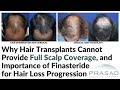 Why Hair Transplants Are Not Advised for Young Men, and Cannot Provide Full Scalp Coverage