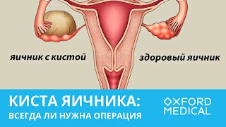 КИСТА ЯИЧНИКА: всегда ли нужна операция