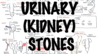 Urinary/Kidney Stones - Overview (signs and symptoms, risk factors, pathophysiology, treatment)