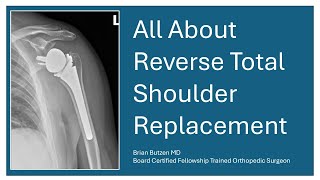Reverse Total Shoulder Replacement Surgery - A Surgeon's Complete Explanation