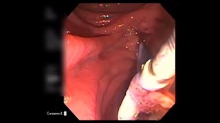 Retrieval of migrated biliary stent