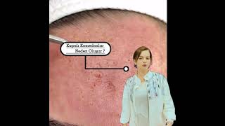 kapali komedon nasil temizlenir video klip mp4 mp3