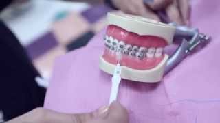 How to Floss and Brush Properly if You Have Braces