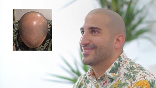 Scalp Micropigmentation Los Angeles, CA | Scalp Micro USA