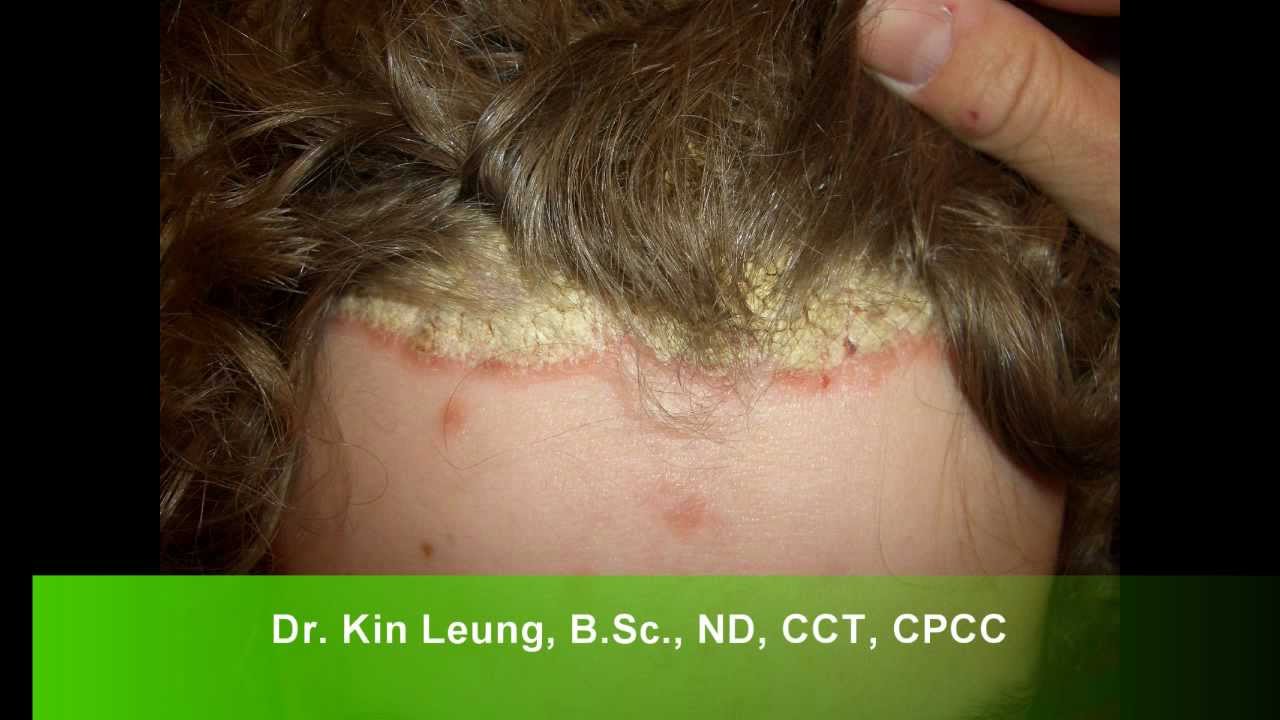 Dr Kin Leung Naturopathic Case Review Patient With Psoriasis Vulgaris