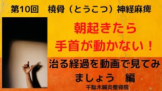 第10回　橈骨神経麻痺　麻痺になった方が治っていく過程を動画で日付順で紹介しています。どういう経過で治っていくのかをみてみましょう