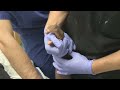 distal radius fracture reduction and hematoma block