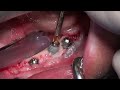 implant removal