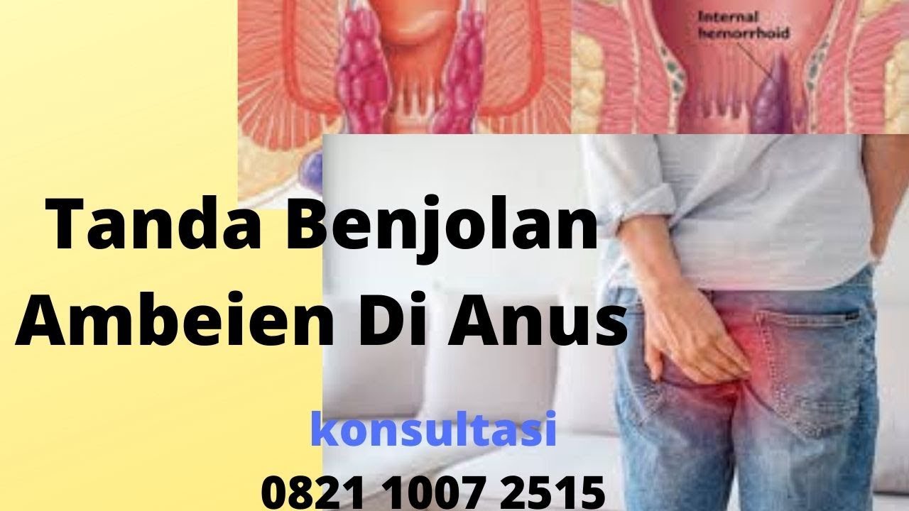 Tanda Benjolan Ambeien Di Anus - YouTube