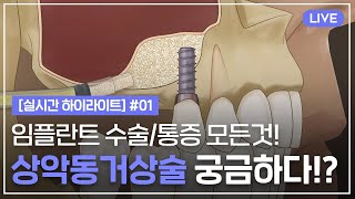 [실시간 하이라이트] 임플란트 A부터 Z까지❗️❗️ 상악동거상술/수술/과정/통증 궁금하면 드루와~드루와~~💡 EP-01