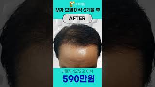 모발이식비용 비절개 4272모이식 590만원 #모발이식#모발이식비용#모발이식전후