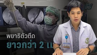 พยาธิตัวตืด ภัยเงียบที่น่ากลัว - เคลียร์ชัดกับเภสัชกรร้านยากรุงเทพ