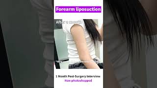 Forearm liposuction 1Month Pos-surgery Review