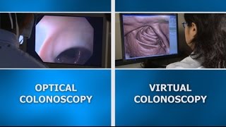 Colonoscopy screening: Virtual vs. optical colonoscopy