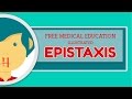 What is Epistaxis (Nosebleed)?