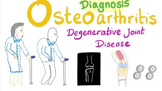 Osteoarthritis (OA) - Diagnosis - Rheumatology Series