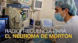 Radiofrecuencia del Neuroma de Morton