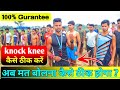 Knock knee kaise thik kare 😱| knock knee solution | knock knee best exercise | knock knee treatment