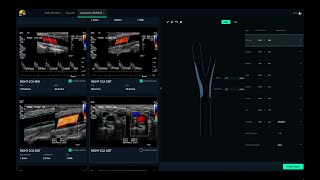 Introducing See Mode AVA: World's first AI software for vascular ultrasound