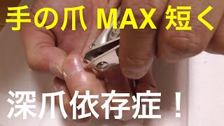 限界まで短く手の爪を切る 深爪 Cut the nail of the hand shortly to the limit Deep nail