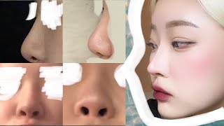 #Nose reoperation 드디어 코 재수술! 코재수술 3개월 차의 수술 후기, 코재수술 이유, 코수술 일주일 후기 (feat. 내돈내산)