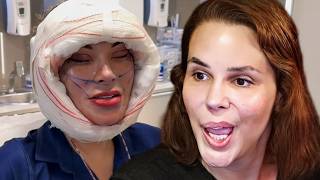 Andressa Urach shows details of her FACELIFT SURGERY