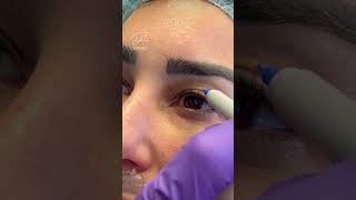 Upper Eyelid Blepharoplasty