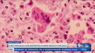 First measles case reported in New Mexico for 2025