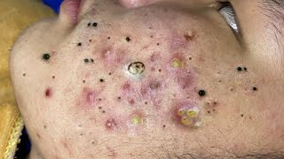 Big Cystic Acne Blackheads Extraction Blackheads \u0026 Milia, Whiteheads Removal Pimple Popping # 1702