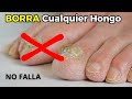 ¡Destruye los Hongos en tus Uñas en Solo 3 DÍAS con Este Poderoso Remedio Casero!