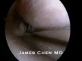 Arthroscopic Partial Medial Meniscectomy