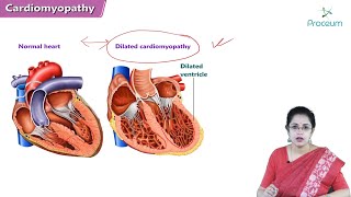 Cardiomyopathy (Hindi) : Etiology, Clinical Features, Diagnosis, Treatment | Internal Medicine