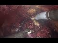 201 simultaneous radical nephroureterectomy and cystectomy with hugotm ras... drs. basile u0026 breda