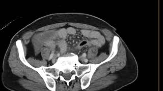 Acute Appendicitis