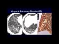 CT evaluation of interstitial lung disease small airway disease