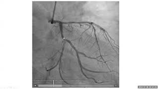 Coronary Angiography Cases, Dr. Abdullah Al khushail