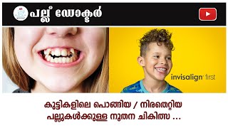 കുട്ടികളിലെ പൊങ്ങിയ/ നിരതെറ്റിയ പല്ലുകൾക്കുള്ള ചികിത്സ ...Invisalign First /Invisalign Teen for kids