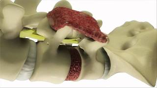 Transforaminal Lumbar Interbody Fusion (TLIF) Surgery - DePuy Back &/Spine