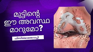 മുട്ടിന്റെ ഈ അവസ്ഥ മാറുമോ? knee osteoarthritis