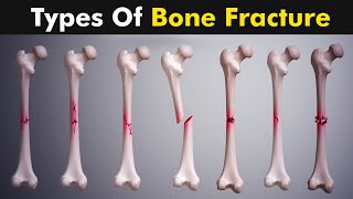 Common types of Bone fracture | 3D animation |