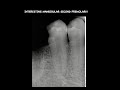 ENDO TALES FROM LIFE-STORY OF AN INTERESTING MANDIBULAR PREMOLAR