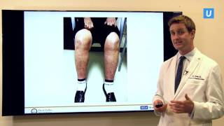 IVC Filters: What You Need to Know | John Moriarty, MD | UCLAMDChat