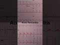 acute pericarditis ecg widespread st segment elevation