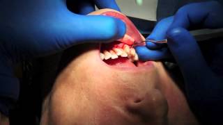 Deppeler Smart Scaling, 2 instruments for a complete periodontal debridement