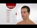 what is the norwood hair loss scale for men